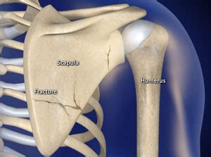 Treating Shoulder Blade (Scapula) Fractures in Plano, Frisco, McKinney ...