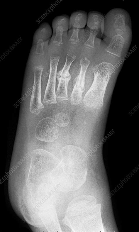 Xray Broken Foot