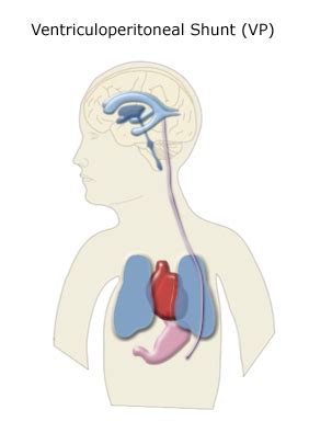 Lumboperitoneal Shunt Technique