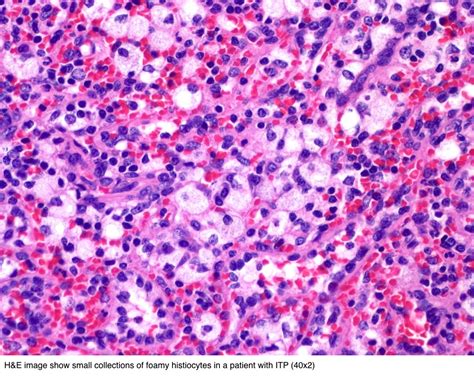 Pathology Outlines - Foamy macrophages