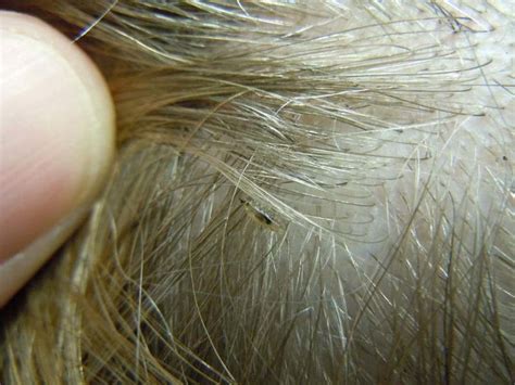 How to Check for Lice & Nits