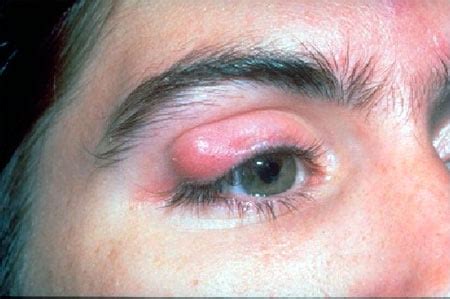 Eye Chalazion | Causes, Treatment And Diagnosis | Stye vs Chalazion