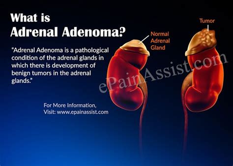 What is Adrenal Adenoma? | Adrenals, Adrenal fatigue, Endocrine disorders