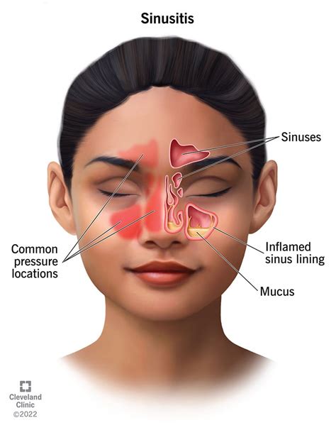 Sinus Infection (Sinusitis): Causes, Symptoms Treatment | atelier-yuwa ...