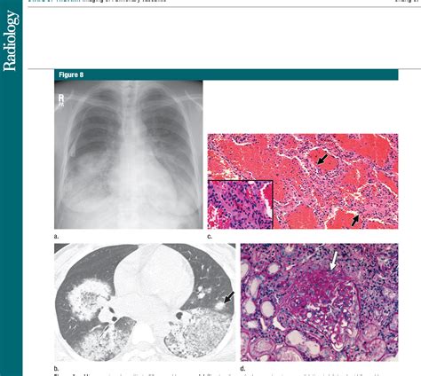 Figure 18 from Imaging of pulmonary vasculitis. | Semantic Scholar