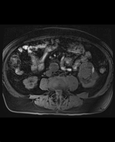 Renal Cell Carcinoma — Clinical MRI