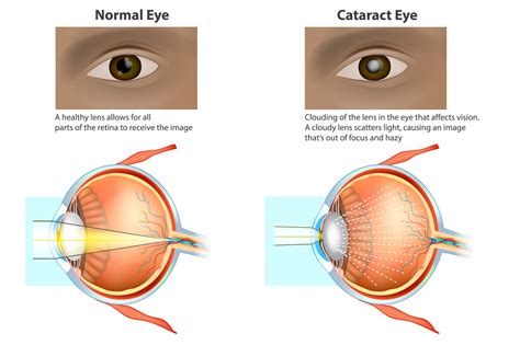 Causes of Early Onset Cataracts - Eastside Eye