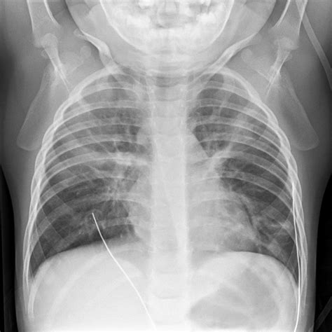 Acute Bronchitis Chest X Ray