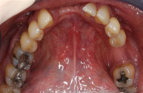 How Are Sinus Infections Related To Toothache? : Dental Implants