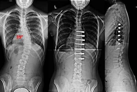 Non-fusion Corrective Scoliosis Surgery - Scoliosis and Spine Associates