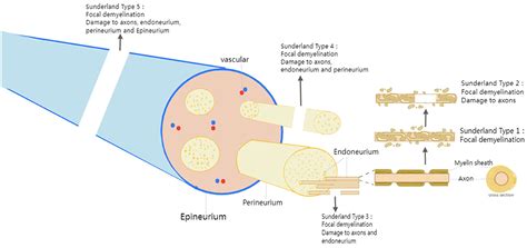 Frontiers | Electrical stimulation therapy for peripheral nerve injury