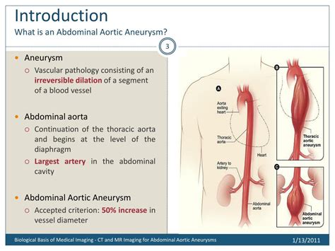 Ppt Ct And Mr Imaging Of Abdominal Aortic Aneurysm Powerpoint | Images ...