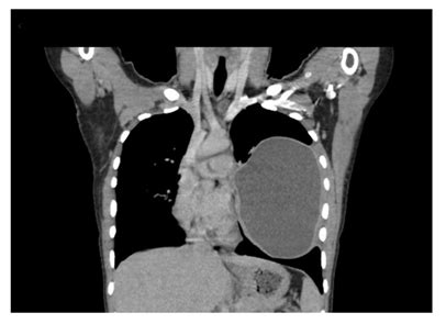 Lung Hydatid Cysts in Children, Evaluation and Surgical Management