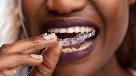 Byte Aligners Review: Are They Worth It? – Forbes Health