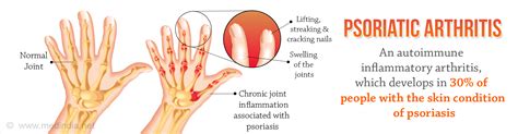 Psoriatic Arthritis - Types, Causes, Risk Factors, Diagnosis, Treatment ...