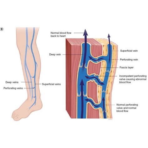 Liquidation Of Perforant Veins