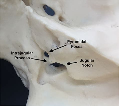 Jugular Foramen Syndrome