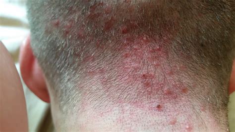 Scalp Folliculitis Hair Loss regarding Desire