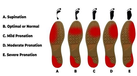 Pronation And Supination Whats All That About - Ariki Holidays