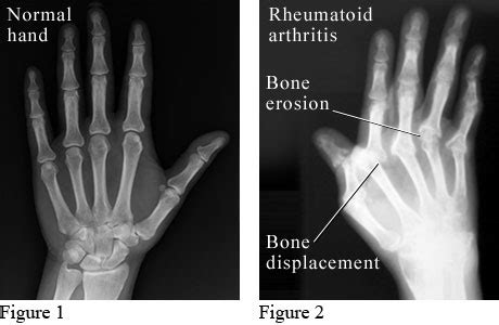 X-Ray of Rheumatoid Arthritis in the Hands | University of Michigan ...