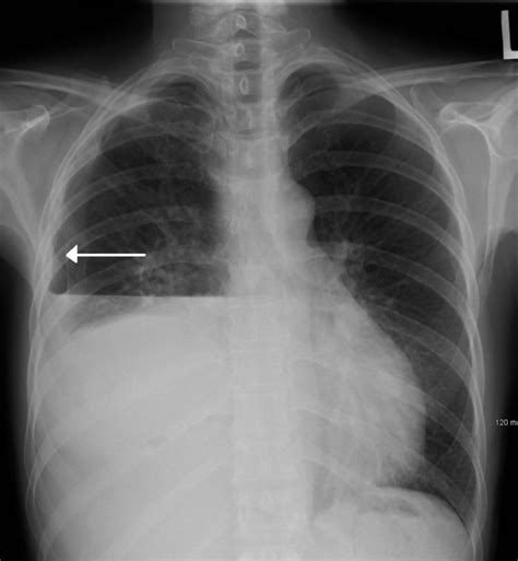 Hydropneumothorax - Alchetron, The Free Social Encyclopedia