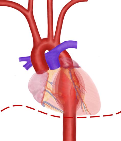 Thoracic Aortic Aneurysms - Clinical Features - Management - TeachMeSurgery