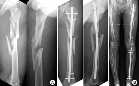 Comminuted Fracture Diagram