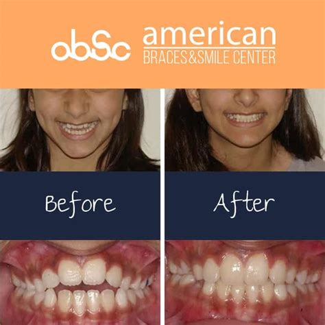 Braces Under Bite Adult Before And After