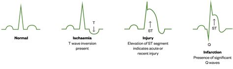 Diagnosis and management of stable angina - The Pharmaceutical Journal