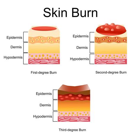 Free Sunburn Severity Chart: Check Your Health