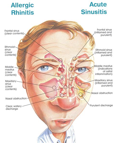 allergic rhinitis vs acute sinusitis | Allergic rhinitis, Sinusitis ...