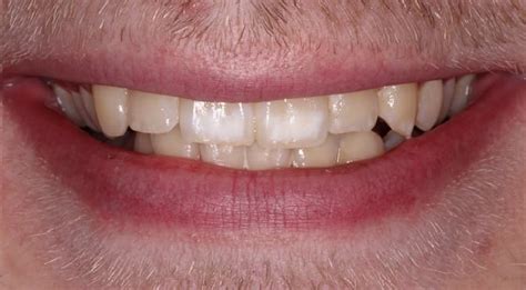 Different Types Of White Spots On Teeth And What They Mean, 44% OFF