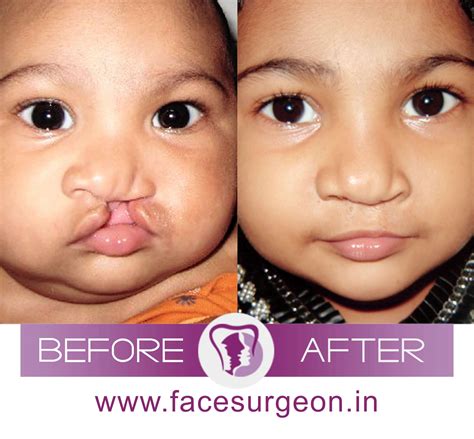 Unilateral Cleft Nose Rhinoplasty: Surgery and Treatment in India