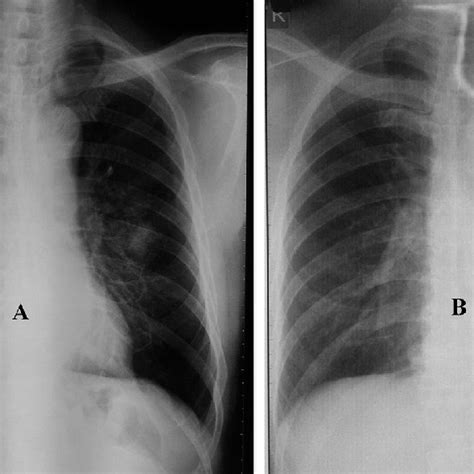 A: Chest X-ray showed the left perihilar oval shaped consolidation. B ...