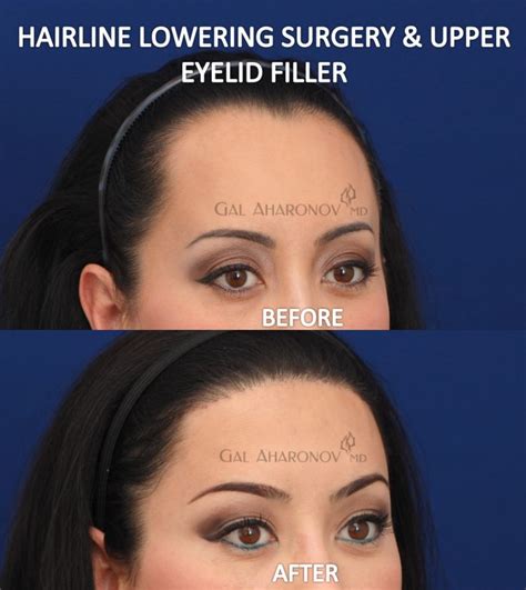 Forehead Reduction Surgery Hairline Lowering Surgery Before and After ...