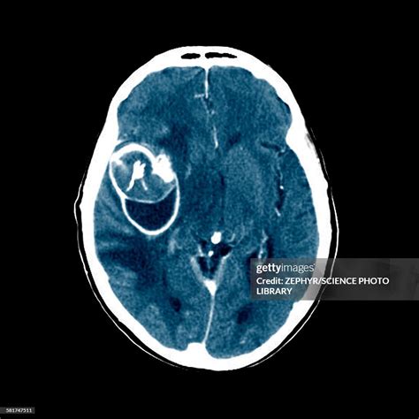 Aneurysm Ct Scan High-Res Stock Photo - Getty Images