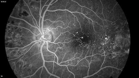 Fluorescein Angiography | Ophthalmologists | Island Retina