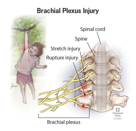 Brachial Plexus Injury: What It Is, Symptoms, Treatment, 44% OFF