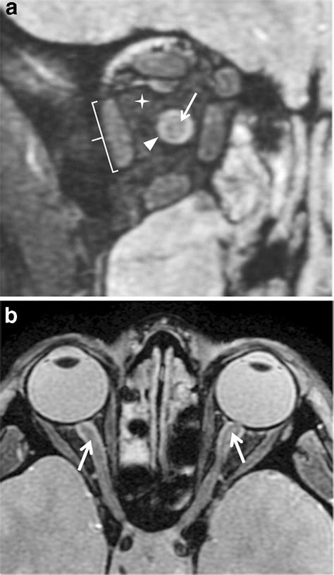 Normal anatomy of the optic nerves on susceptibility-weighted MRI. a ...