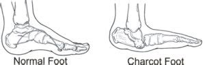 Charcot Foot: Causes, Symptom, Treatment & Complication » How To Relief