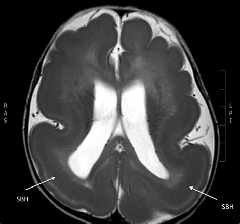 Lissencephaly Mri