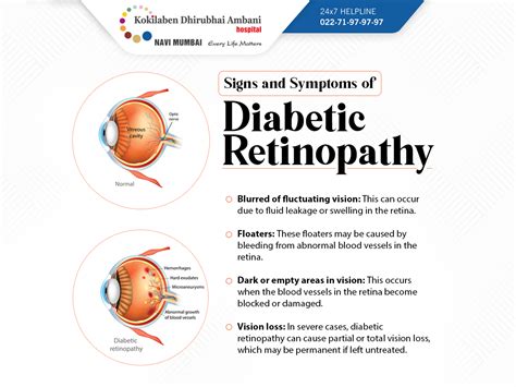 Signs and symptoms of diabetic retinopathy