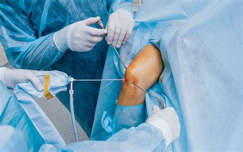 Knee arthroscopy: changing practice | InSight+