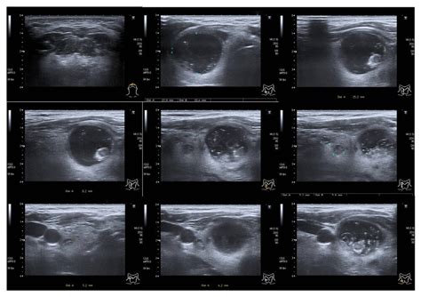 Supreme How To Understand Thyroid Ultrasound Results What Is Technical ...