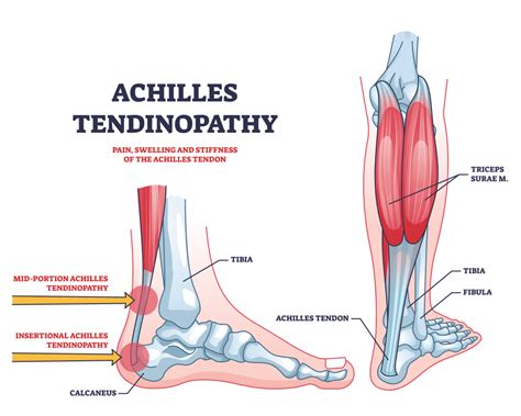 Understanding Achilles Tendinitis: A Guide for Recreational Runners ...