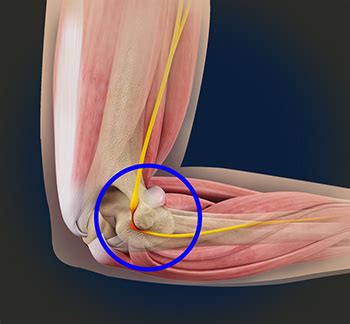 Ulnar Nerve Entrapment Cheshire | Cubital Tunnel Syndrome Stafford ...