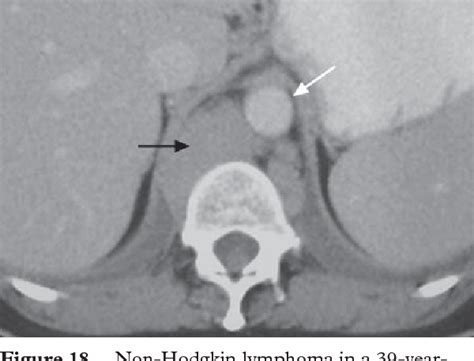 The diaphragmatic crura and retrocrural space: normal imaging ...