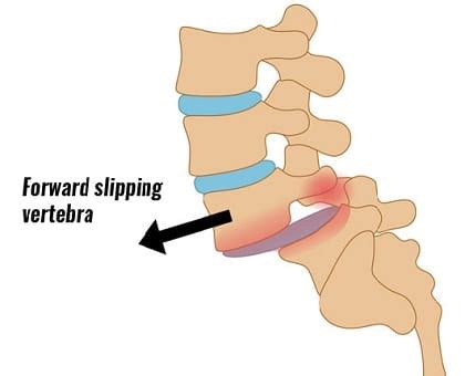 What is Spondylolisthesis? Causes & Symptoms | Spine & Orthopedic Center