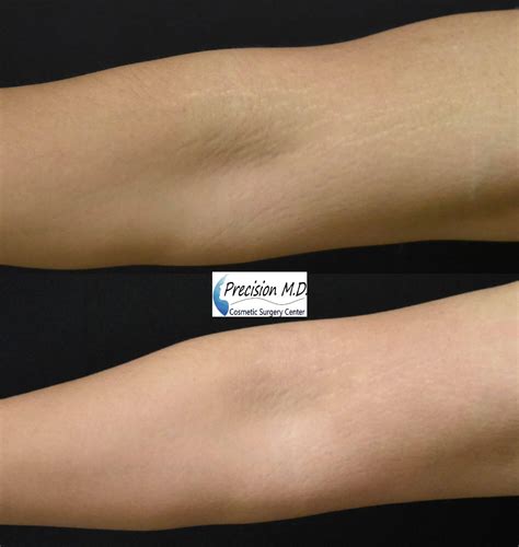 Laser Stretch Mark Removal Sacramento | Stretch Marks Treatment