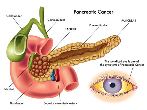 Pancreatic Cancer Incidence and Survival Rates By Stage of Pancreatic ...